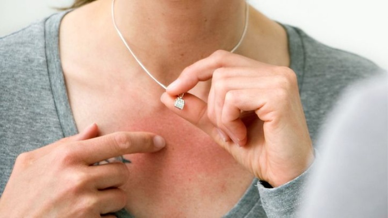Oxidation can turn skin green in some cases; this is a common symptom of wearing these metals.